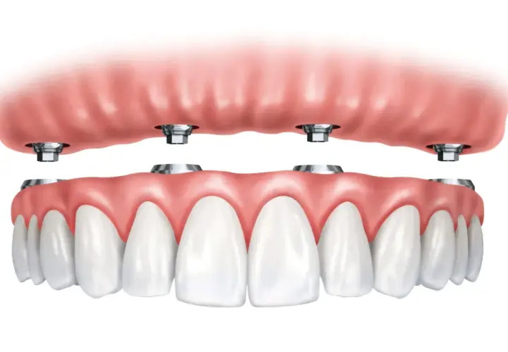 Arcata dentale superiore con impianti dentali. La protesi superiore si aggancia a quattro pilastri metallici.