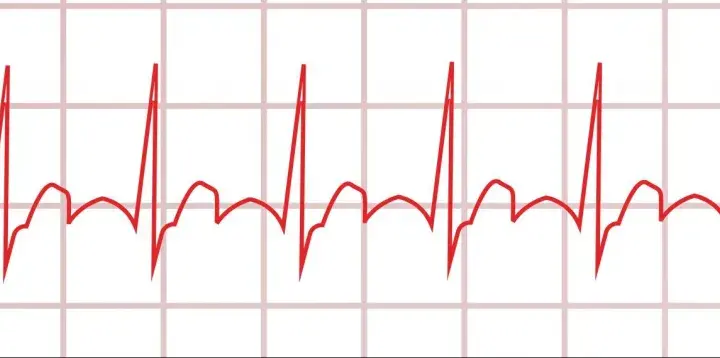 Myokarditis Diagnostik EKG: EKG-Befunde verstehen und richtig deuten