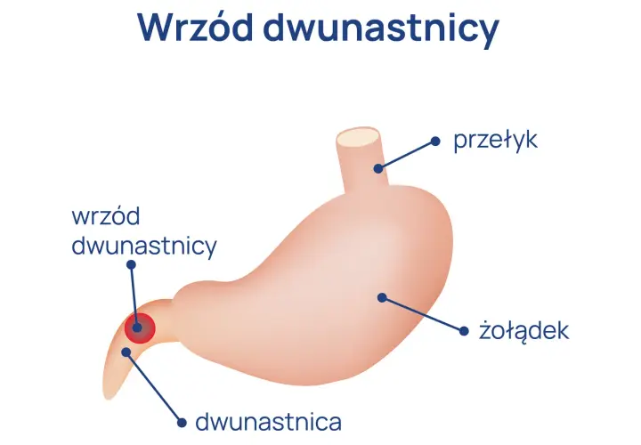 Ból dwunastnicy - objawy, które powinieneś znać. Diagnostyka