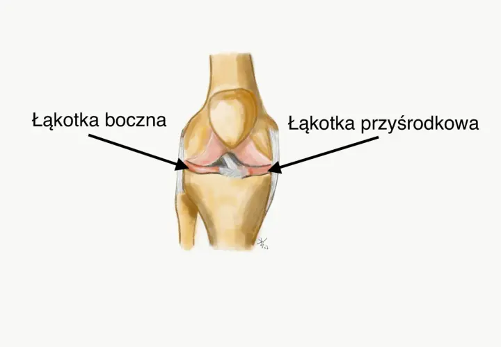 Ilustracja przedstawia staw kolanowy z zaznaczonymi łąkotkami: boczną i przyśrodkową.
