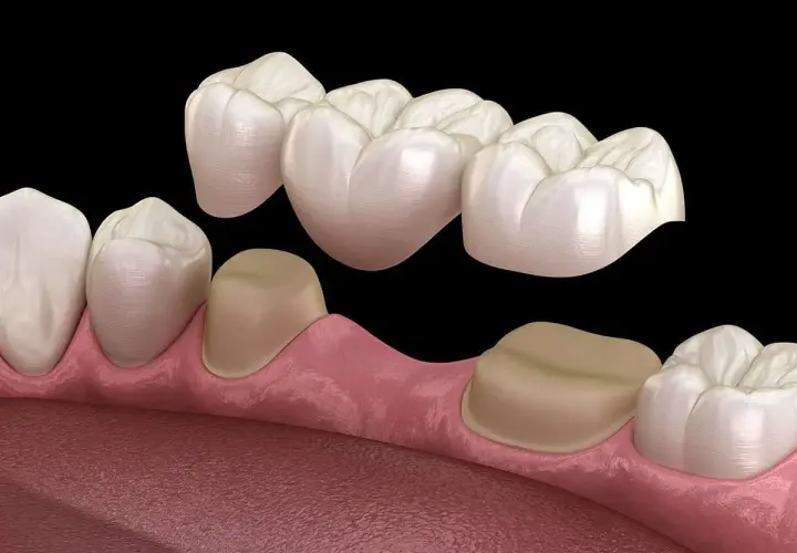 Un ponte dentale che sostituisce un dente mancante, ancorato a corone su denti adiacenti.