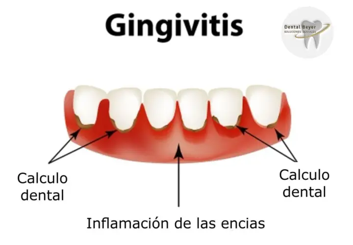 Encías inflamadas y con sarro, indicando gingivitis grave. Se observa cálculo dental y la inflamación de las encías.