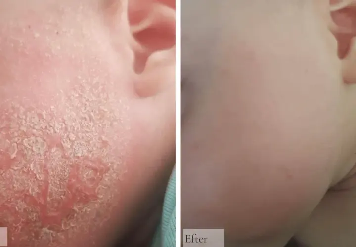 Före och efter-bilder som visar ett barns ansikte med svårt eksem bebis, som sedan läkt och blivit mjuk och fin.