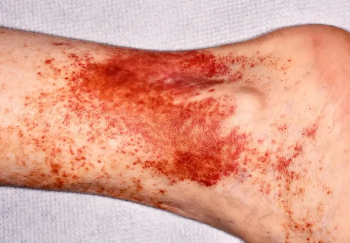 Piel con manchas oscuras y rojizas en la zona del tobillo y la parte baja de la pierna, indicando posibles hematomas o petequias.