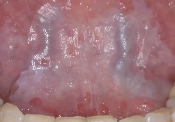 Vista detallada de la lengua mostrando áreas blanquecinas y rojizas, indicativas de leucoplasia en la lengua.