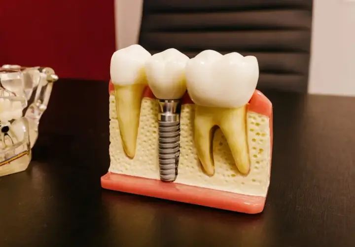Model szczęki z zębami i mikroimplantem ortodontycznym. Pokazuje, jak implant zastępuje korzeń zęba.