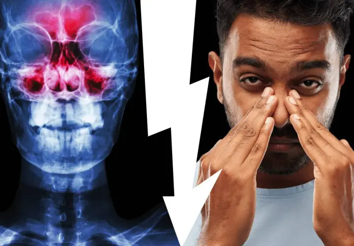 Radiografia del cranio che mostra l'anatomia del seno mascellare infiammato, accanto a un uomo che si tocca il naso per il dolore.