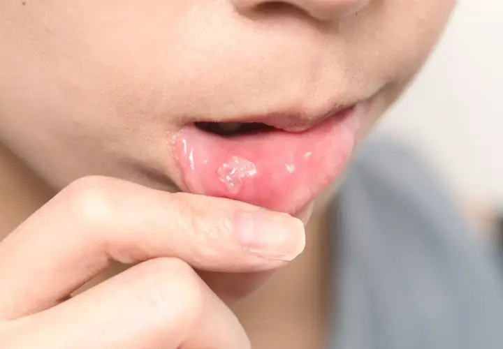 Persona tocándose el labio inferior, mostrando una llaga dolorosa. Busca información sobre estomatitis tratamiento.