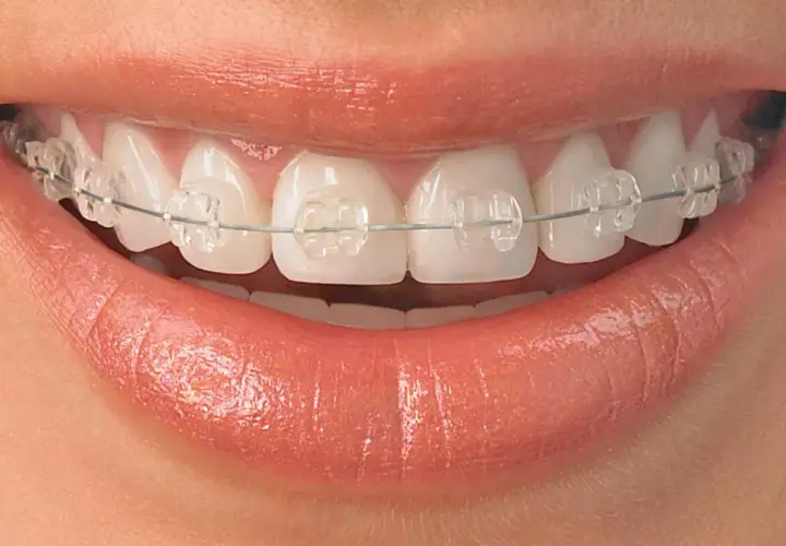 Sonrisa con brackets transparentes, mostrando dientes que necesitan brackets para alinearse y lucir perfectos.