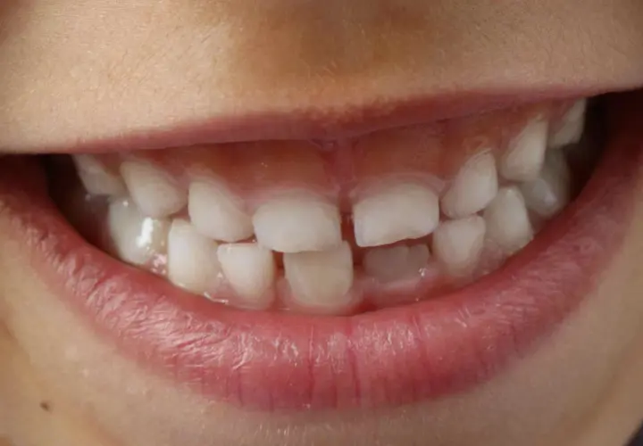 Sorriso di bambino con denti bianchi e sani, ma con segni di ipomineralizzazione denti bambini.