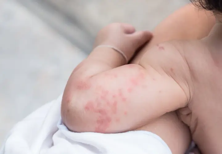 Braccio di un neonato con eritema, macchie rosse e pruriginose sulla pelle.