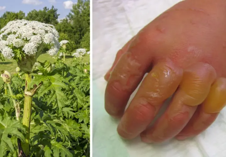 Riesige Herkulesstaude neben einer Hand mit schweren Brandblasen, die durch Kontakt mit der Pflanze entstanden sind.