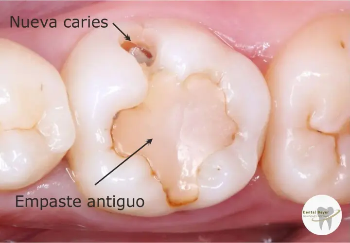 Diente con empaste antiguo y nueva caries. El empaste ha cedido, dejando espacio para la caries.