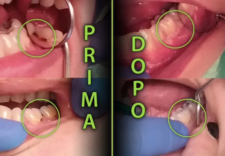Prima e dopo il trattamento di una carie al colletto dentale. La carie è visibile in verde.