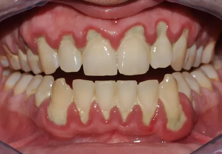 Gengive infiammate e retratte, con accumuli giallastri alla base dei denti, mostrano perché vengono le placche e i problemi che causano.