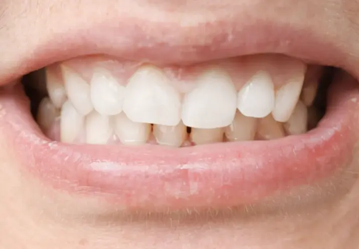 Primer plano de una boca con dientes blancos y labios rosados. Se observa una mordida profunda, donde los dientes superiores cubren significativamente los inferiores.