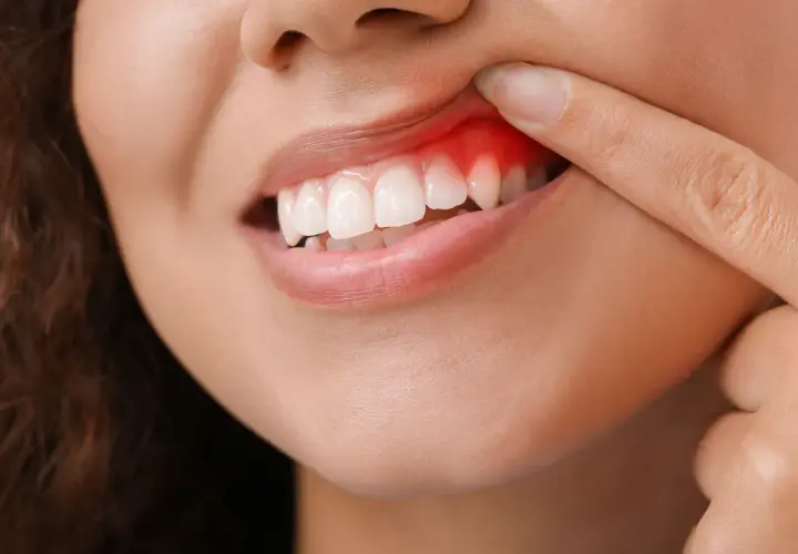 Dito indice indica un'infiammazione gengive, con arrossamento e gonfiore visibili attorno ai denti.