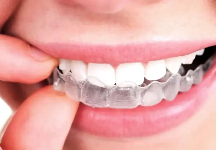 Una persona se ajusta un alineador transparente. Aunque el tratamiento es discreto, a veces el **invisalign duele** al principio.