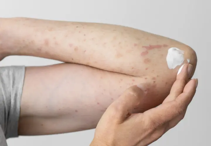 Arm mit roten Flecken und Creme, deutet auf einen **pollenallergie ausschlag** hin.