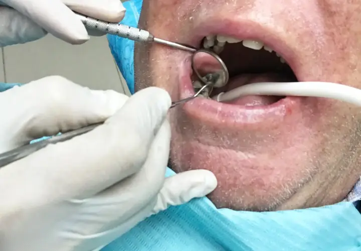 Dentysta usuwa korzeń zęba z ropą. Widać narzędzia stomatologiczne i usta pacjenta.