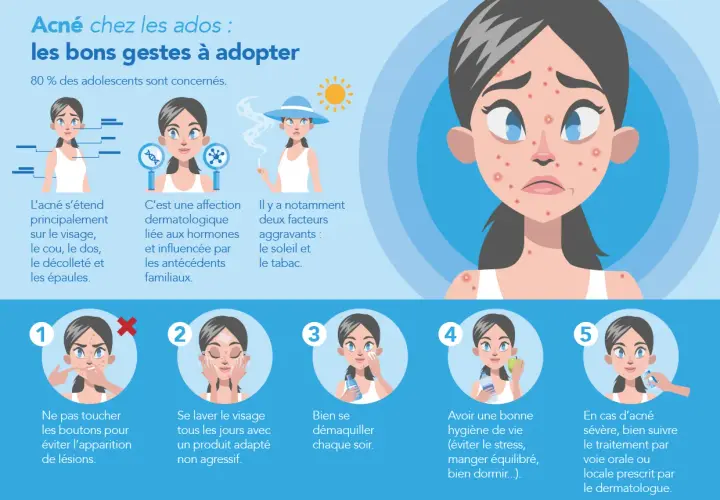 Illustration sur l'acné des adolescents. Cinq étapes pour gérer les boutons de puberté : ne pas toucher, laver, démaquiller, hygiène de vie, consulter un dermatologue.