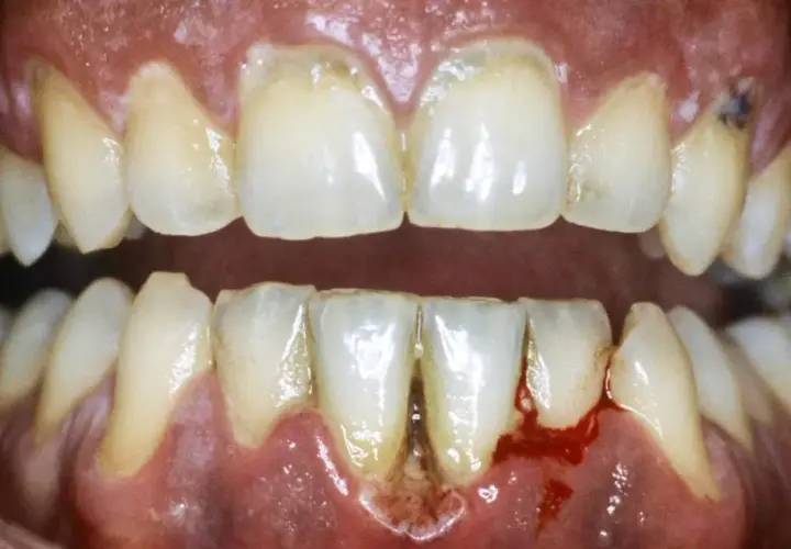 Gengive infiammate e sanguinanti, denti ingialliti e con tartaro, un quadro di dolore alle gengive e denti che necessita cure.