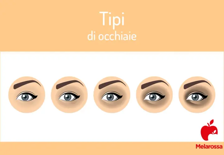 Cinque tipi di occhiaie nere, da leggere a profonde, illustrate con occhi stilizzati.