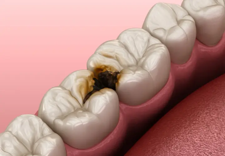 Dente cariato con cavità scura che raggiunge la polpa dentale.