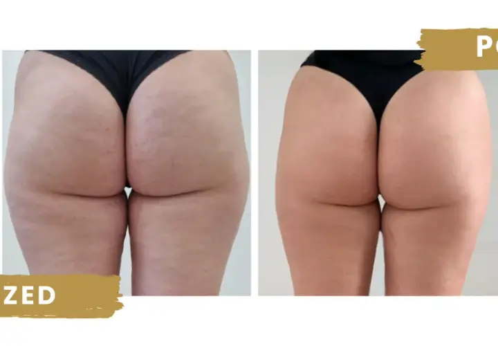 Endermologia czy warto? Szczera ocena efektów, kosztów i ryzyk.