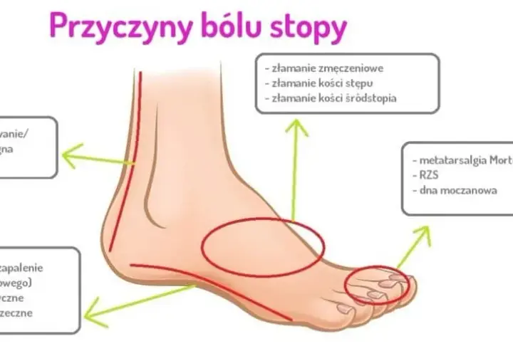 Ból stopy: Kiedy to alarm? Poznaj przyczyny i objawy