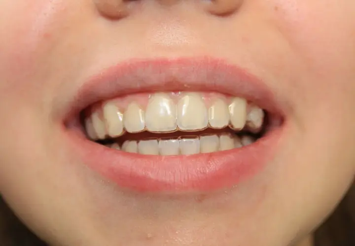 Uśmiech z aparatem Invisalign. Widoczne przezroczyste nakładki na zębach, które korygują zgryz. Efekty leczenia są już widoczne.