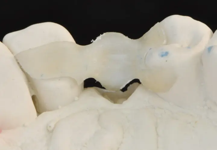 Modello di protesi dentale, un ponte Maryland, che sostituisce denti mancanti.