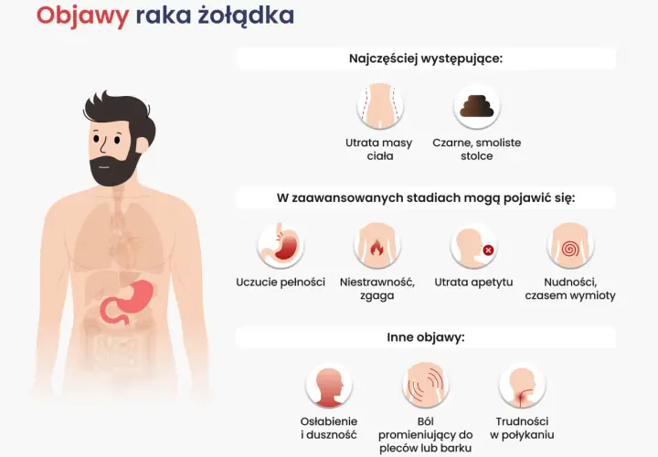 Objawy raka żołądka: utrata masy ciała, czarne stolce, niestrawność, nudności, ból pleców, trudności w połykaniu.