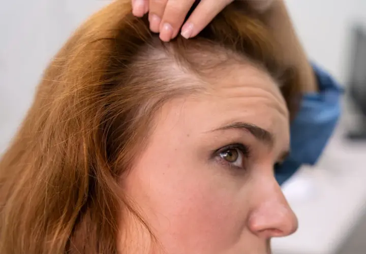 Mujer revisando su cabello, mostrando signos de efluvio telógeno recuperación.