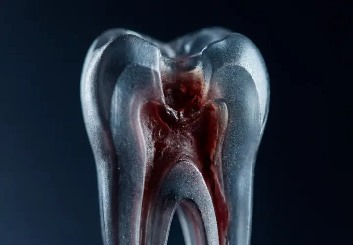 Modello di dente con polpa infiammata, che illustra i sintomi di un ascesso dentale.