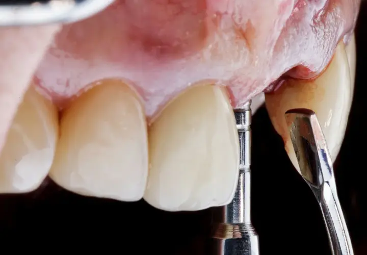 Dettaglio di un impianto dentale provvisorio in fase di posizionamento, con strumenti dentistici e denti in primo piano.
