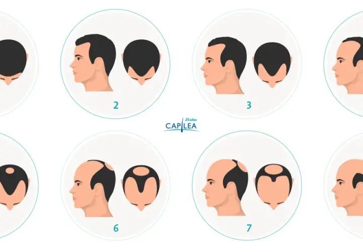 Escala de Norwood que muestra la progresión de la pérdida de cabello, desde una densidad capilar completa hasta la calvicie.