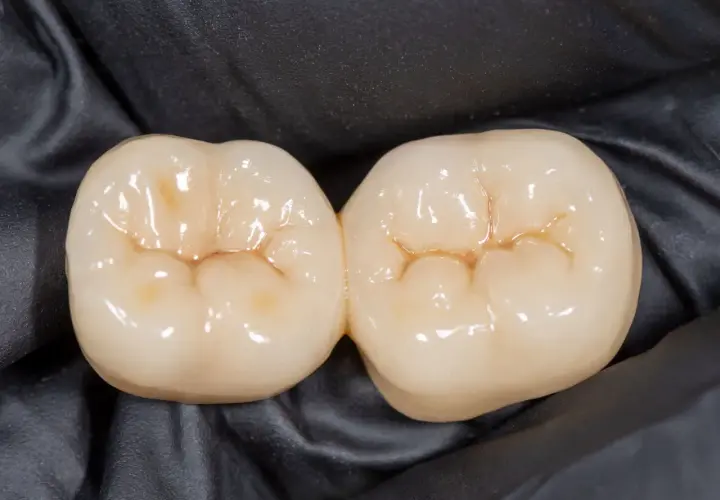 Dwa połączone zęby ceramiczne z widocznymi bruzdami na zębach, gotowe do odbudowy uśmiechu.
