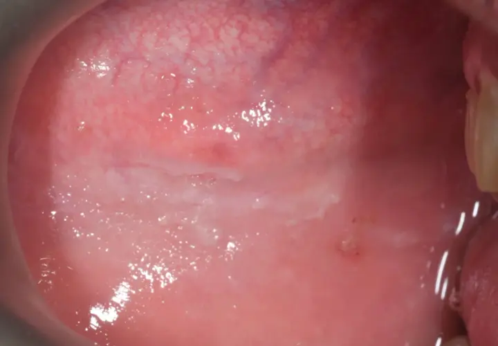 Guancia interna con lesione biancastra, possibile esito di un morso. Rimedi naturali per favorire la guarigione.
