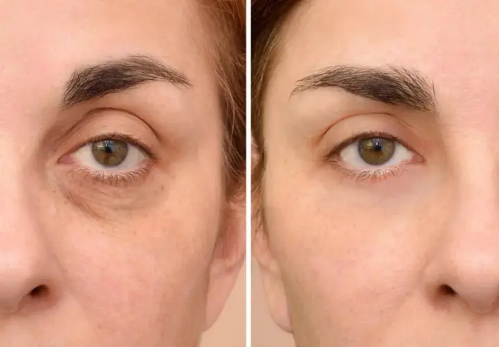 Antes y después de un tratamiento para quitar ojeras oscuras. La piel luce más luminosa y descansada.