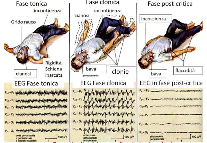 Illustrazione delle fasi di una crisi epilettica tonico-clonica: rigidità, cianosi, incontinenza, bava, clonie, incoscienza. Sintomi premonitori e EEG.