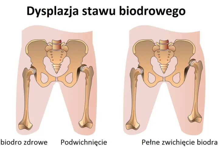 Ilustracja porównuje zdrowe biodro z dysplazją stawu biodrowego u dorosłych, pokazując podwichnięcie i pełne zwichnięcie.