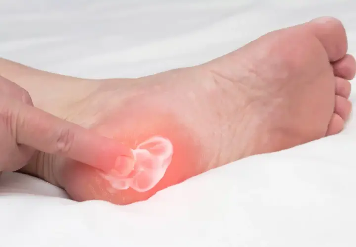 Application d'une crème pour soulager la douleur d'une aponévrosite plantaire. Un doigt masse la zone rouge sur le talon.