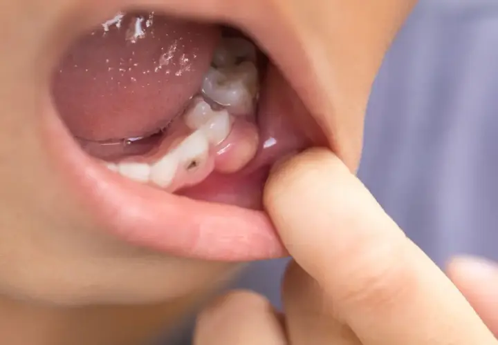 Boca con diente cariado y encía inflamada. Podría ser necesario un tratamiento de pulpotomía que es.