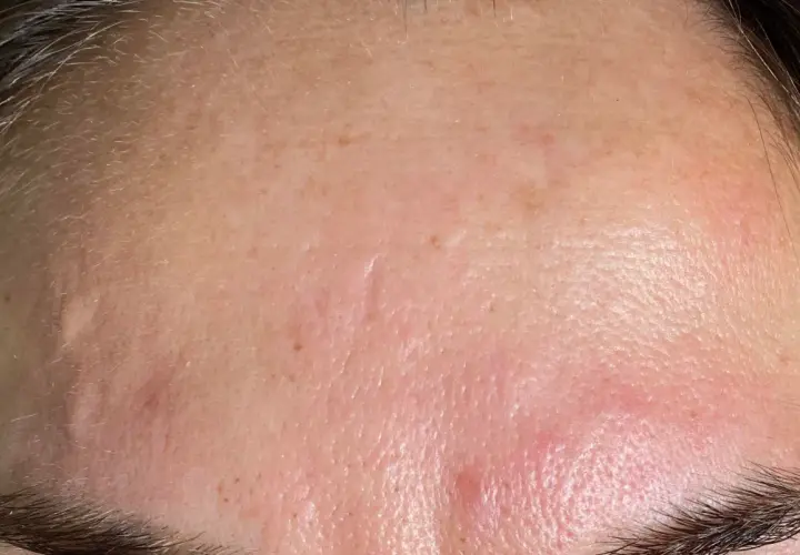Närbild på en panna med en inflammerad finne som syns tydligt. Huden har även små ojämnheter.