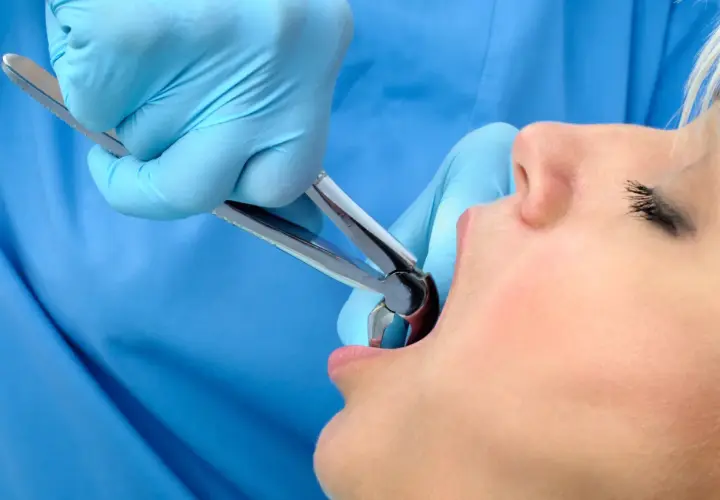Dentysta w niebieskich rękawiczkach używa kleszczy do ekstrakcji zęba, pozostawiając dziwny posmak po wyrwaniu zęba.