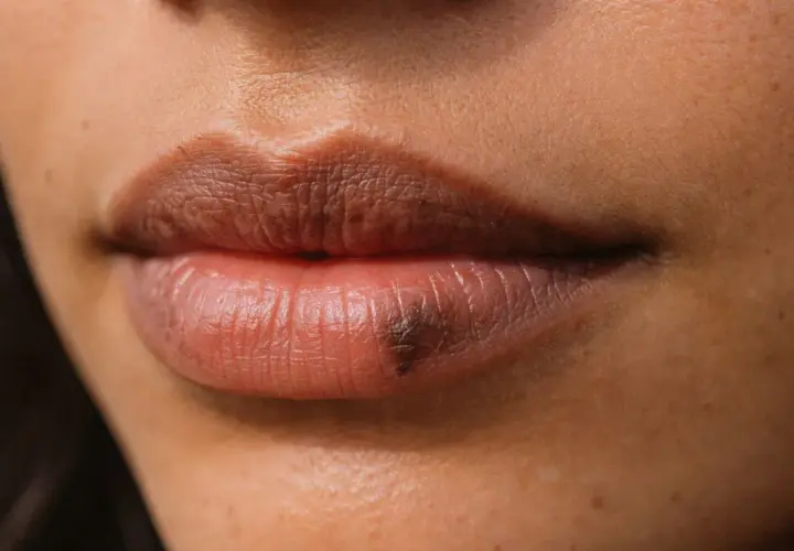 Primer plano de unos labios con una mancha oscura en el labio inferior.