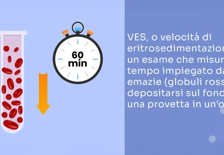 Provetta con globuli rossi e cronometro indicano un esame VES, utile per rilevare un'infezione ai denti o altre infiammazioni.
