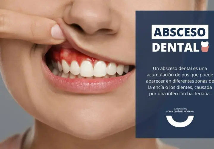 Primer plano de una boca mostrando encías rojas e inflamadas, indicativo de un absceso en la encía. Texto informativo sobre abscesos dentales.