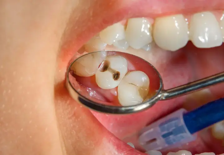 Primo piano di un dente bucato, visibile in uno specchietto dentale. La carie ha creato una cavità scura.